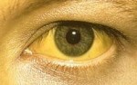 Sárga sclera - de ennyire azért ritkán